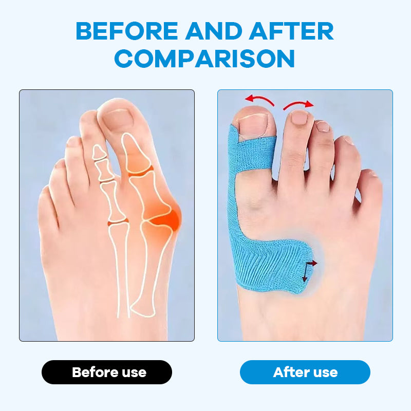 👣Előre kivágott hallux valgus korrekciós kineziológiai tapasz